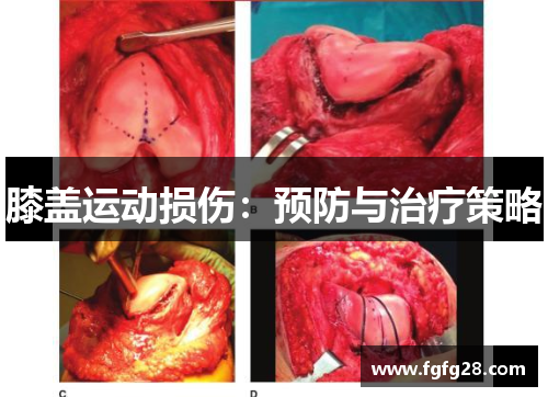 膝盖运动损伤：预防与治疗策略